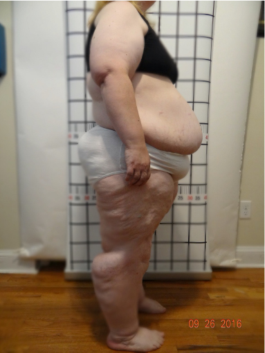 Lipedema Treatment Network – Connect with qualified providers for  state-of-the-art, gentle and effective Lipedema treatment